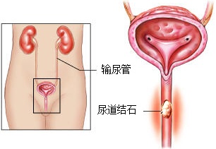 尿道结石360°解析(图1)